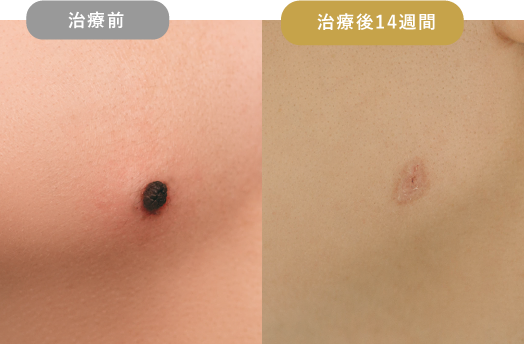 ニキビ跡・クレーター 症例写真