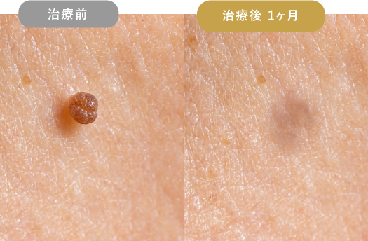 ニキビ跡・クレーター 症例写真