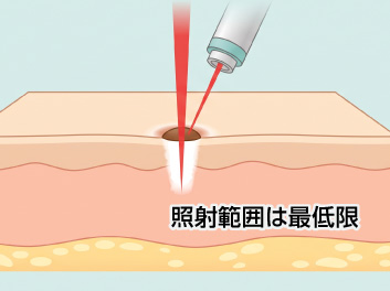 ピンポイント照射で周囲へのダメージを最小限に