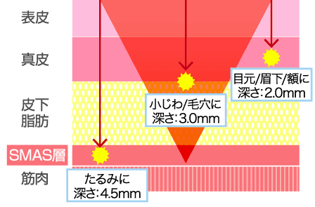 ハイフ Hifu 効果はいつから現れる エステと医療ハイフの違いを解説 名古屋 池袋 新宿の医療 永久脱毛ならリアラクリニック